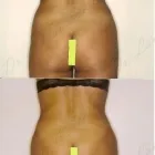 173 üzleti kép ZSÍRLESZÍVÁS KLINIKA DR LÁNYI CECÍLIA Plasztikai sebészet ban/ben Budapest