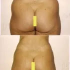 180 üzleti kép ZSÍRLESZÍVÁS KLINIKA DR LÁNYI CECÍLIA Plasztikai sebészet ban/ben Budapest