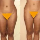 183 üzleti kép ZSÍRLESZÍVÁS KLINIKA DR LÁNYI CECÍLIA Plasztikai sebészet ban/ben Budapest