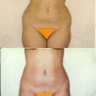 185 üzleti kép ZSÍRLESZÍVÁS KLINIKA DR LÁNYI CECÍLIA Plasztikai sebészet ban/ben Budapest