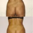 190 üzleti kép ZSÍRLESZÍVÁS KLINIKA DR LÁNYI CECÍLIA Plasztikai sebészet ban/ben Budapest