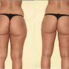 200 üzleti kép ZSÍRLESZÍVÁS KLINIKA DR LÁNYI CECÍLIA Plasztikai sebészet ban/ben Budapest