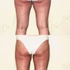 213 üzleti kép ZSÍRLESZÍVÁS KLINIKA DR LÁNYI CECÍLIA Plasztikai sebészet ban/ben Budapest