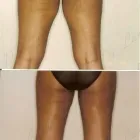 214 üzleti kép ZSÍRLESZÍVÁS KLINIKA DR LÁNYI CECÍLIA Plasztikai sebészet ban/ben Budapest