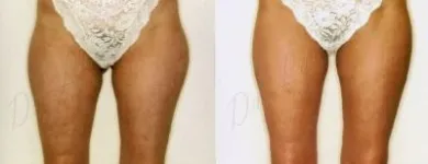 3 üzleti kép ZSÍRLESZÍVÁS KLINIKA DR LÁNYI CECÍLIA Plasztikai sebészet ban/ben Budapest