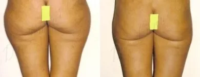 4 üzleti kép ZSÍRLESZÍVÁS KLINIKA DR LÁNYI CECÍLIA Plasztikai sebészet ban/ben Budapest