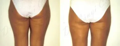 5 üzleti kép ZSÍRLESZÍVÁS KLINIKA DR LÁNYI CECÍLIA Plasztikai sebészet ban/ben Budapest