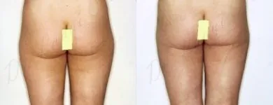 6 üzleti kép ZSÍRLESZÍVÁS KLINIKA DR LÁNYI CECÍLIA Plasztikai sebészet ban/ben Budapest