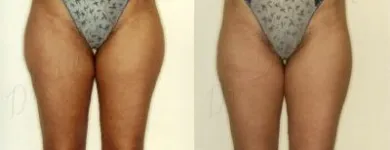 10 üzleti kép ZSÍRLESZÍVÁS KLINIKA DR LÁNYI CECÍLIA Plasztikai sebészet ban/ben Budapest