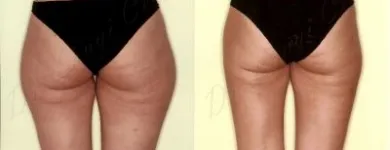 25 üzleti kép ZSÍRLESZÍVÁS KLINIKA DR LÁNYI CECÍLIA Plasztikai sebészet ban/ben Budapest