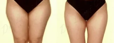 30 üzleti kép ZSÍRLESZÍVÁS KLINIKA DR LÁNYI CECÍLIA Plasztikai sebészet ban/ben Budapest