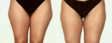 32 üzleti kép ZSÍRLESZÍVÁS KLINIKA DR LÁNYI CECÍLIA Plasztikai sebészet ban/ben Budapest