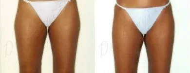 37 üzleti kép ZSÍRLESZÍVÁS KLINIKA DR LÁNYI CECÍLIA Plasztikai sebészet ban/ben Budapest