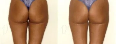 40 üzleti kép ZSÍRLESZÍVÁS KLINIKA DR LÁNYI CECÍLIA Plasztikai sebészet ban/ben Budapest