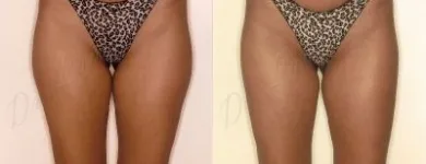 45 üzleti kép ZSÍRLESZÍVÁS KLINIKA DR LÁNYI CECÍLIA Plasztikai sebészet ban/ben Budapest