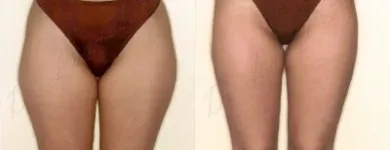 48 üzleti kép ZSÍRLESZÍVÁS KLINIKA DR LÁNYI CECÍLIA Plasztikai sebészet ban/ben Budapest