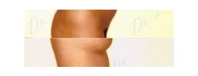 80 üzleti kép ZSÍRLESZÍVÁS KLINIKA DR LÁNYI CECÍLIA Plasztikai sebészet ban/ben Budapest