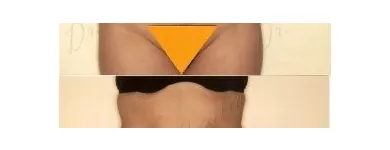 81 üzleti kép ZSÍRLESZÍVÁS KLINIKA DR LÁNYI CECÍLIA Plasztikai sebészet ban/ben Budapest