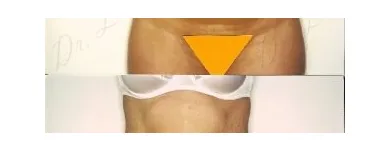 95 üzleti kép ZSÍRLESZÍVÁS KLINIKA DR LÁNYI CECÍLIA Plasztikai sebészet ban/ben Budapest