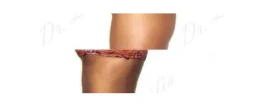 114 üzleti kép ZSÍRLESZÍVÁS KLINIKA DR LÁNYI CECÍLIA Plasztikai sebészet ban/ben Budapest