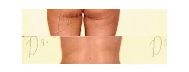 168 üzleti kép ZSÍRLESZÍVÁS KLINIKA DR LÁNYI CECÍLIA Plasztikai sebészet ban/ben Budapest