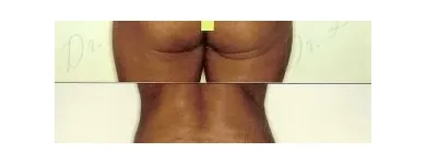 171 üzleti kép ZSÍRLESZÍVÁS KLINIKA DR LÁNYI CECÍLIA Plasztikai sebészet ban/ben Budapest