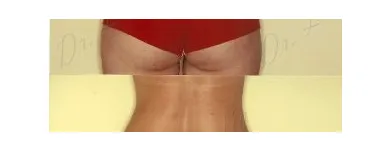 178 üzleti kép ZSÍRLESZÍVÁS KLINIKA DR LÁNYI CECÍLIA Plasztikai sebészet ban/ben Budapest