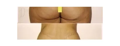 180 üzleti kép ZSÍRLESZÍVÁS KLINIKA DR LÁNYI CECÍLIA Plasztikai sebészet ban/ben Budapest