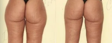 200 üzleti kép ZSÍRLESZÍVÁS KLINIKA DR LÁNYI CECÍLIA Plasztikai sebészet ban/ben Budapest