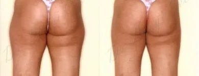 201 üzleti kép ZSÍRLESZÍVÁS KLINIKA DR LÁNYI CECÍLIA Plasztikai sebészet ban/ben Budapest