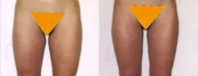 207 üzleti kép ZSÍRLESZÍVÁS KLINIKA DR LÁNYI CECÍLIA Plasztikai sebészet ban/ben Budapest