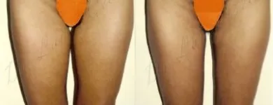 211 üzleti kép ZSÍRLESZÍVÁS KLINIKA DR LÁNYI CECÍLIA Plasztikai sebészet ban/ben Budapest