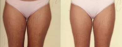 215 üzleti kép ZSÍRLESZÍVÁS KLINIKA DR LÁNYI CECÍLIA Plasztikai sebészet ban/ben Budapest