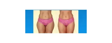 255 üzleti kép ZSÍRLESZÍVÁS KLINIKA DR LÁNYI CECÍLIA Plasztikai sebészet ban/ben Budapest